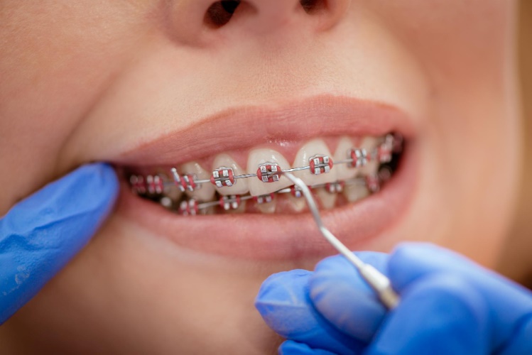 dentist-checking-bracket-braces-female-patient-close-up-real-people500