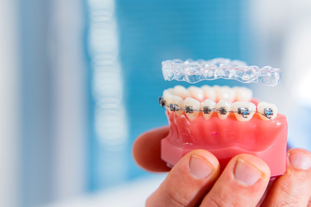 man-holds-his-hand-model-jaw-with-teeth-which-braces-aligners-soar-them