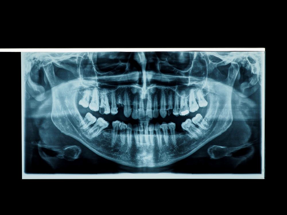 panoramic-x-ray-human-teeth-bones-2